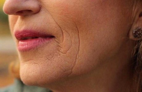 Прощайте морщины вокруг рта: 5 рекомендаций и уколы красоты для их устранения