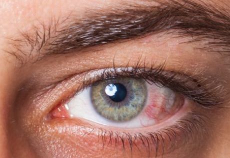 Как избавиться от заметной слезоточивости глаз?