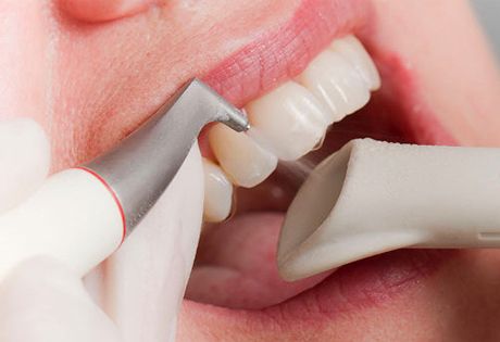 Почему лазерное удаление зубного камня эффективнее?